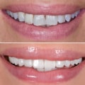 Aftercare for Veneers and Bonding: Maintaining a Beautiful Smile