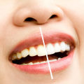 The Benefits of Professional Whitening Treatments for Maintaining Good Oral Health