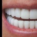 Maintaining White Teeth: Tips and Tricks for a Brighter Smile