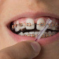 Caring for Teeth During Orthodontic Treatment: A Comprehensive Guide