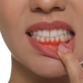 Nutritional Deficiencies and Oral Health: How Diet Affects Your Teeth and Gums