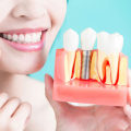 The Benefits of Dental Implants