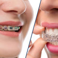 Invisalign vs braces: Which is the best choice for you?