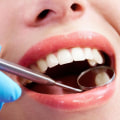 A Comprehensive Look at Different Types of Fillings for Pflugerville Texas Dentists