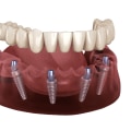 Alternatives to Dentures and Bridges: A Guide for Pflugerville Texas Residents