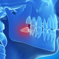 Reasons for Tooth Extraction: Understanding the Basics