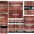 Different Types of Veneers to Enhance Your Smile