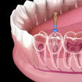 Understanding the Root Canal Procedure: What You Need to Know