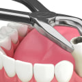 The Extraction Process: A Guide to Understanding Tooth Extractions