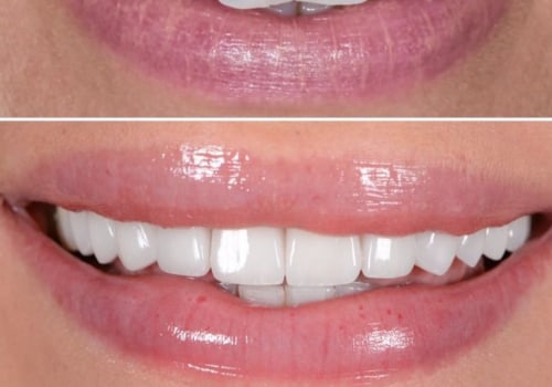 Aftercare for Veneers and Bonding: Maintaining a Beautiful Smile