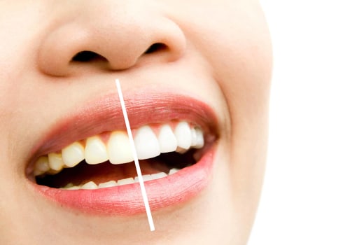 The Benefits of Professional Whitening Treatments for Maintaining Good Oral Health