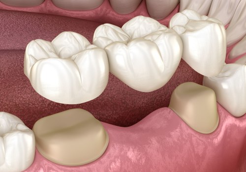 Caring for Dentures and Bridges: Tips from Pflugerville Texas Dentists