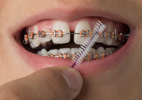 Caring for Teeth During Orthodontic Treatment: A Comprehensive Guide