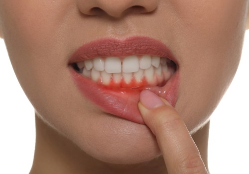 Nutritional Deficiencies and Oral Health: How Diet Affects Your Teeth and Gums