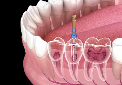 Exercises for TMJ Relief: Improve Your Oral Health and Alleviate Pain