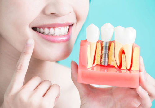 The Benefits of Dental Implants