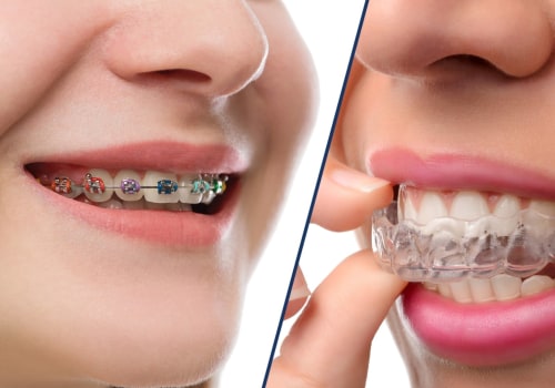 Invisalign vs braces: Which is the best choice for you?