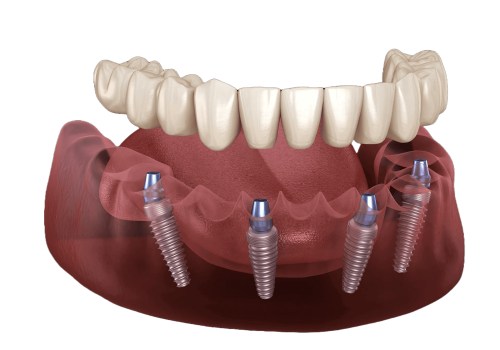 Alternatives to Dentures and Bridges: A Guide for Pflugerville Texas Residents