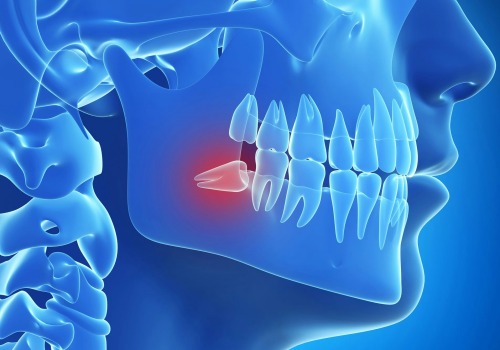 Reasons for Tooth Extraction: Understanding the Basics