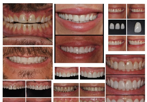 Different Types of Veneers to Enhance Your Smile