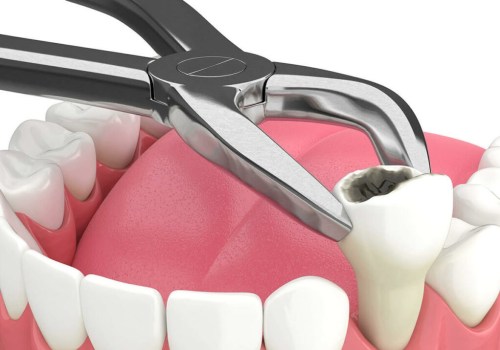 The Extraction Process: A Guide to Understanding Tooth Extractions